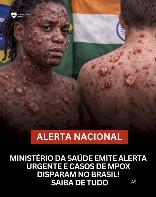 Ministério da Saúde emite alerta urgente após aumento de casos de Mpox no Brasil